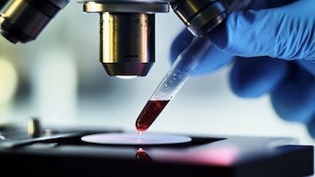 Un análisis de sangre podría agilizar la detección de casos graves de cáncer de próstata
