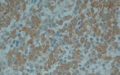 Avances en la validación clínica de una terapia contra un tumor pediátrico agresivo