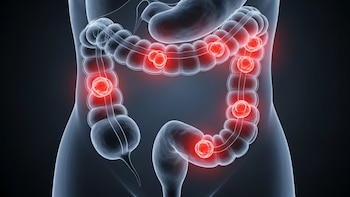 Cuánto se puede demorar el tratamiento del cáncer colorrectal en cada terapia, según una nueva investigación