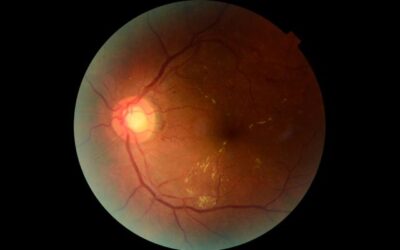 Retinar: la inteligencia artificial desarrollada por investigadores del CONICET que busca prevenir la pérdida visual en personas con diabetes
