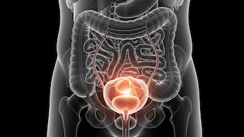 Cómo una IA podría anticipar el riesgo de cáncer de vejiga hasta cinco años antes del diagnóstico