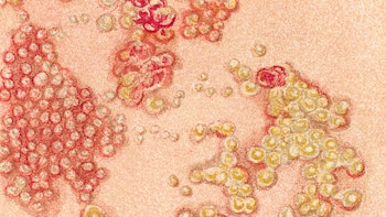 Cuál es la infección que aumenta más de 30% el riesgo de infarto y ACV