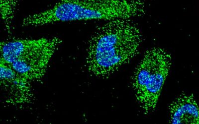 Descubren cómo se comunican las células del cáncer pancreático más frecuente para sobrevivir a condiciones adversas
