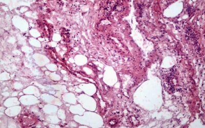 Revelan que el cáncer renal modifica las células grasas de su entorno y genera condiciones que podrían favorecer su progresión