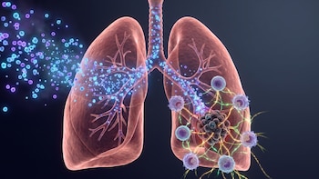 Un estudio identificó células que podrían ayudar al cáncer de pulmón a evadir al sistema inmune